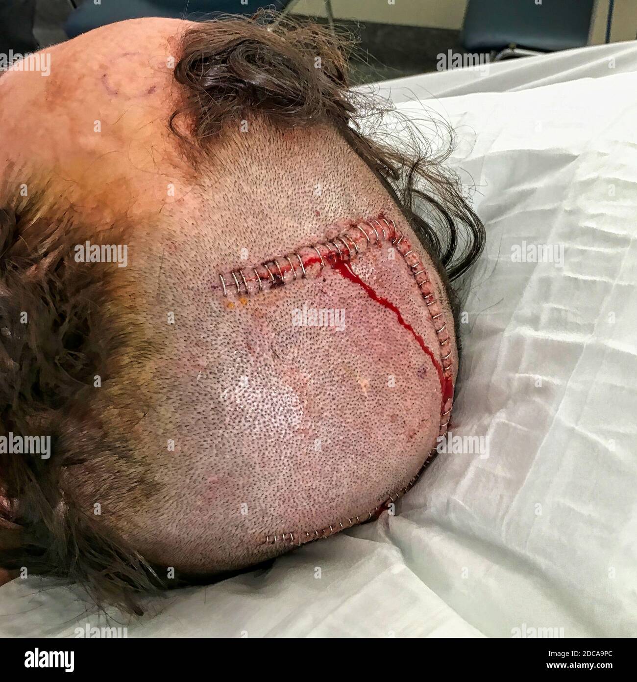 Patient erholt sich nach AVM-Hirnchirurgie Stockfoto