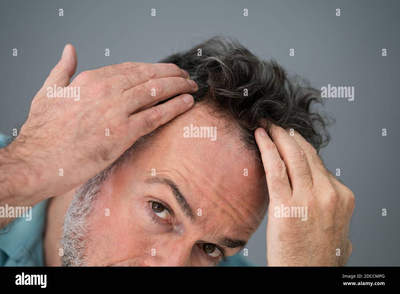 Mann Überprüft Seinen Haarausfall Und Schuppen Stockfoto