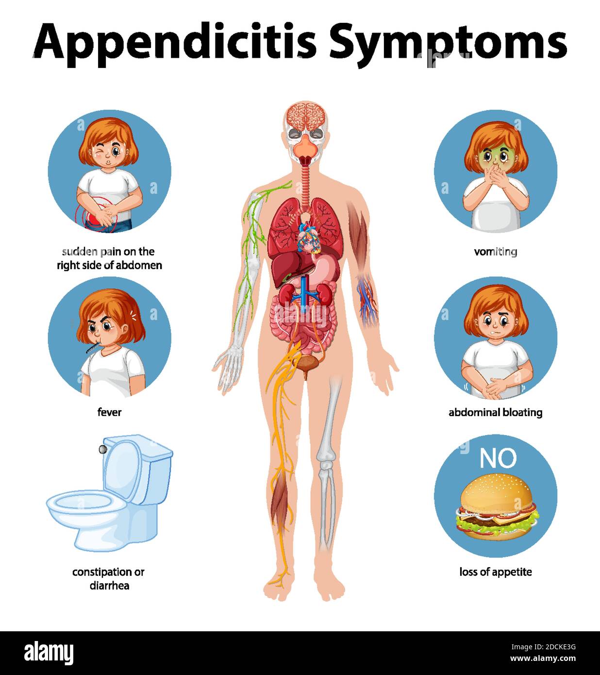 Infografik zur Beschreibung der Symptome von Appendizitis Stock ...