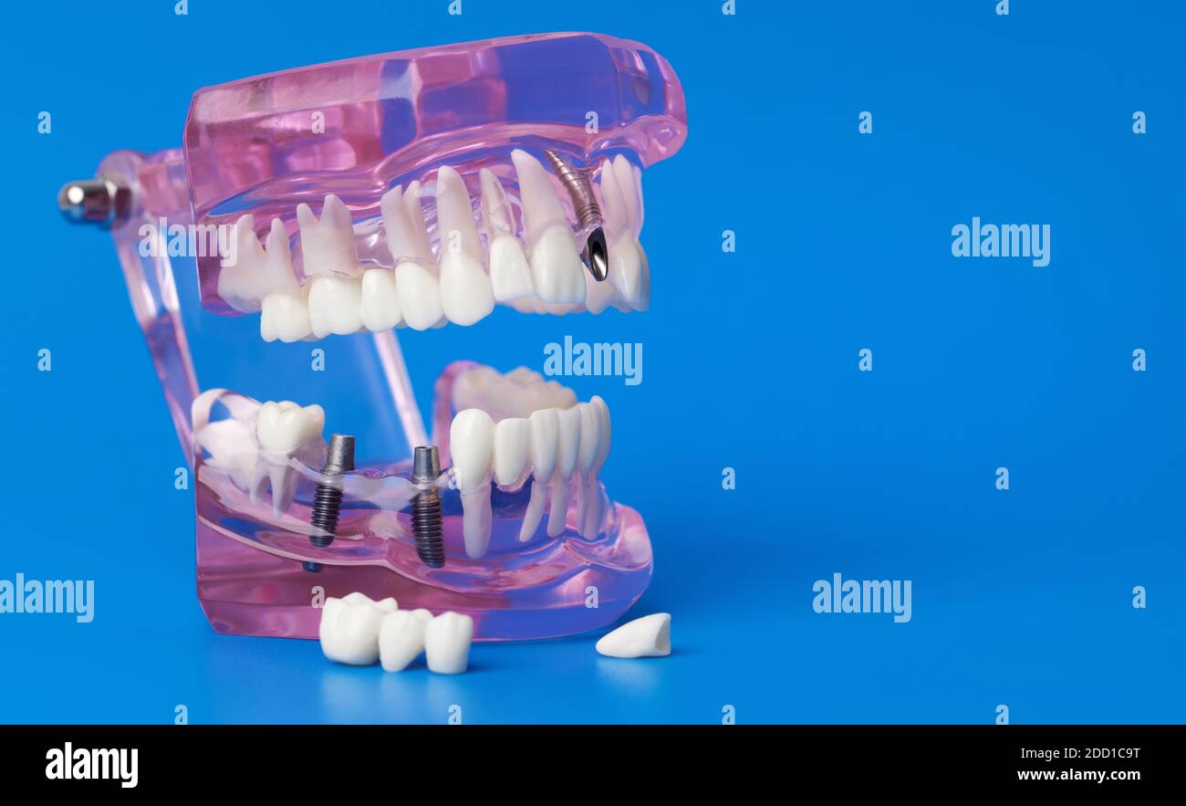 Menschliches Kieferzahnmodell mit Zahnimplantaten auf blauem Hintergrund Mit Kopierbereich Stockfoto