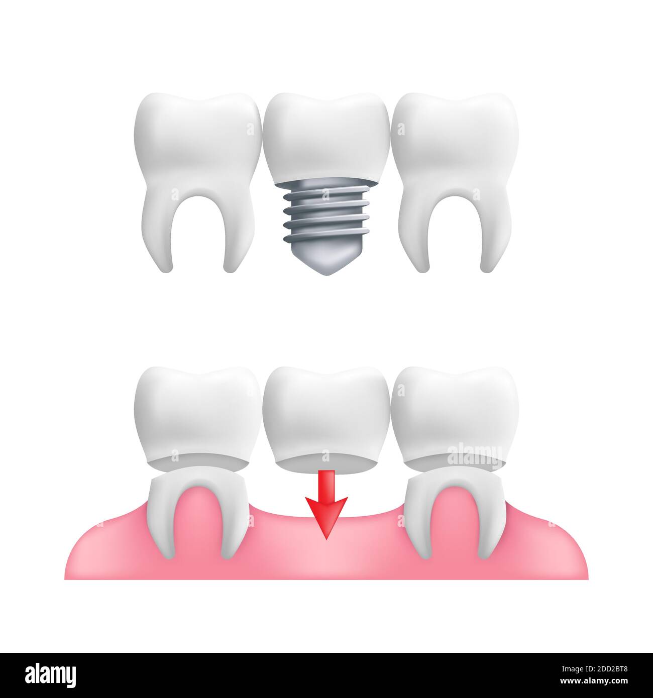 Prothesenkonzept - gesunde Zähne mit festen Zahnbridgearbeit und Implantaten. Vektordarstellung von menschlichen Zähnen in einem 3d realistischen Stil isoliert auf einem wh Stock Vektor