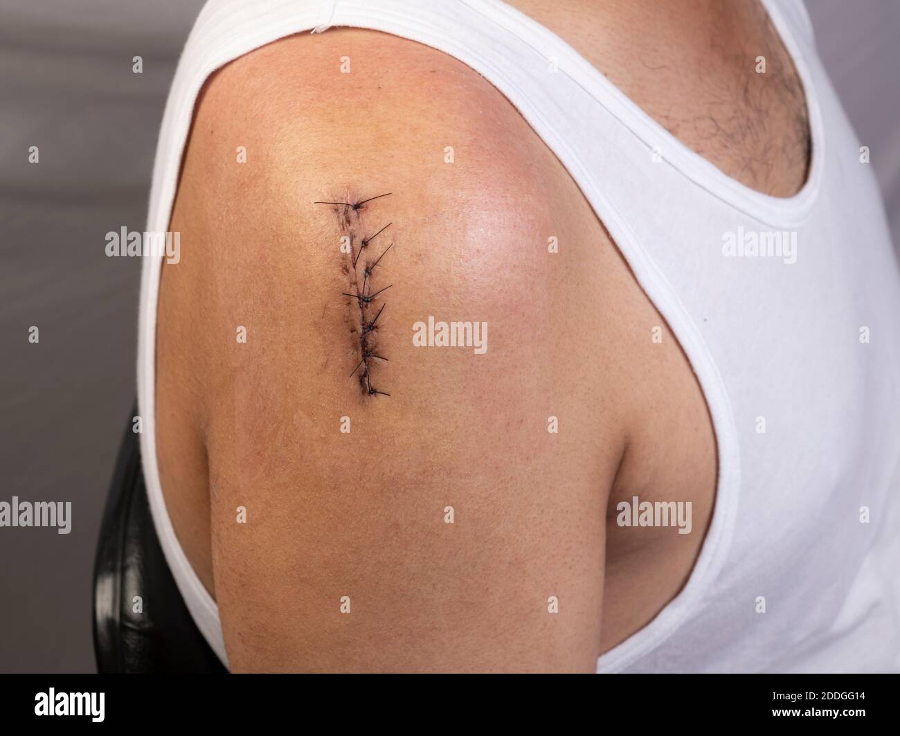 Nahaufnahme des chirurgischen Einschnitts am rechten Schultergelenk geschlossen mit Nähte Stockfoto