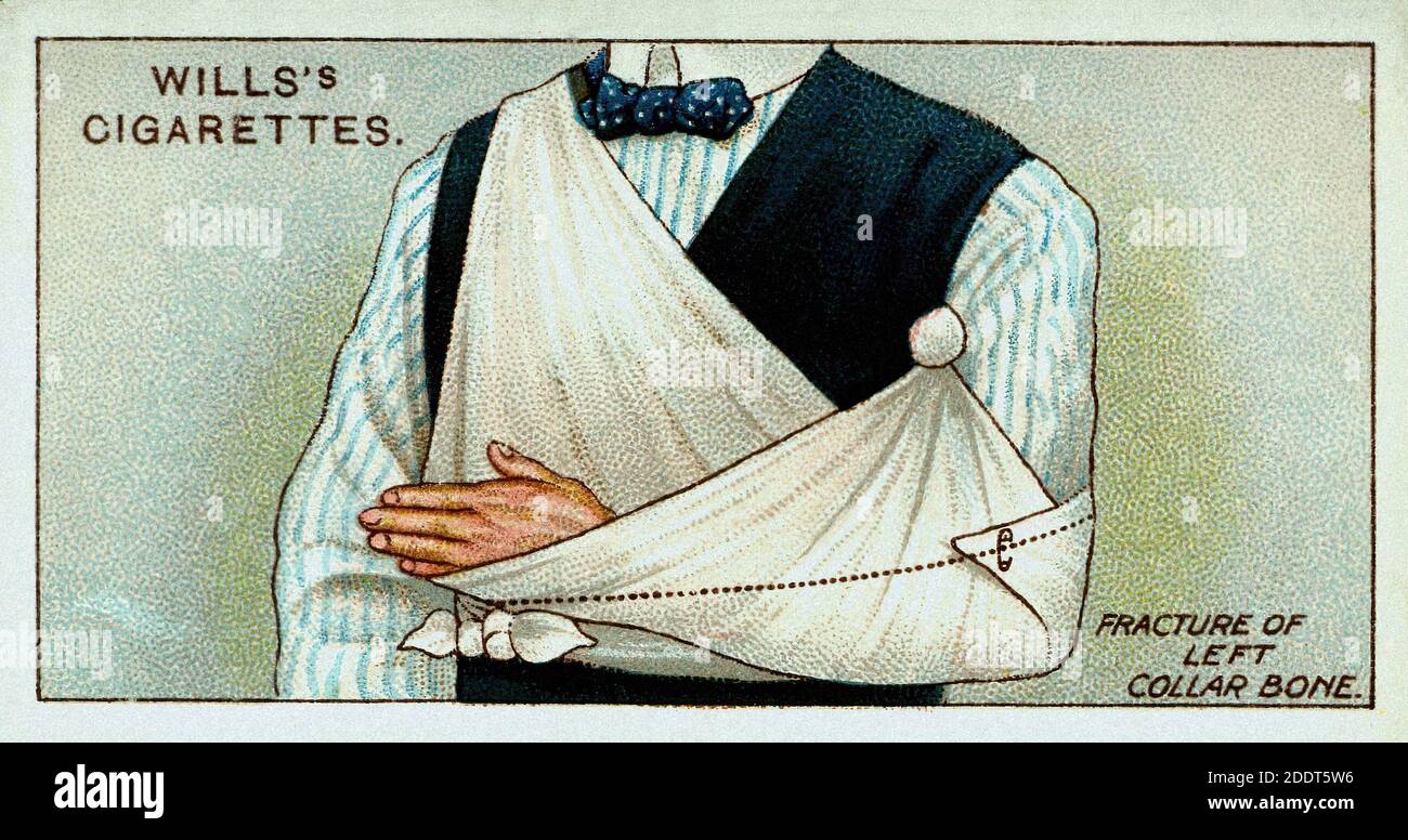 Antike Zigarettenkarten. Wills Zigaretten (Serie erste Hilfe ). Bruch des linken Kragenknochens. England. 1913 Stockfoto