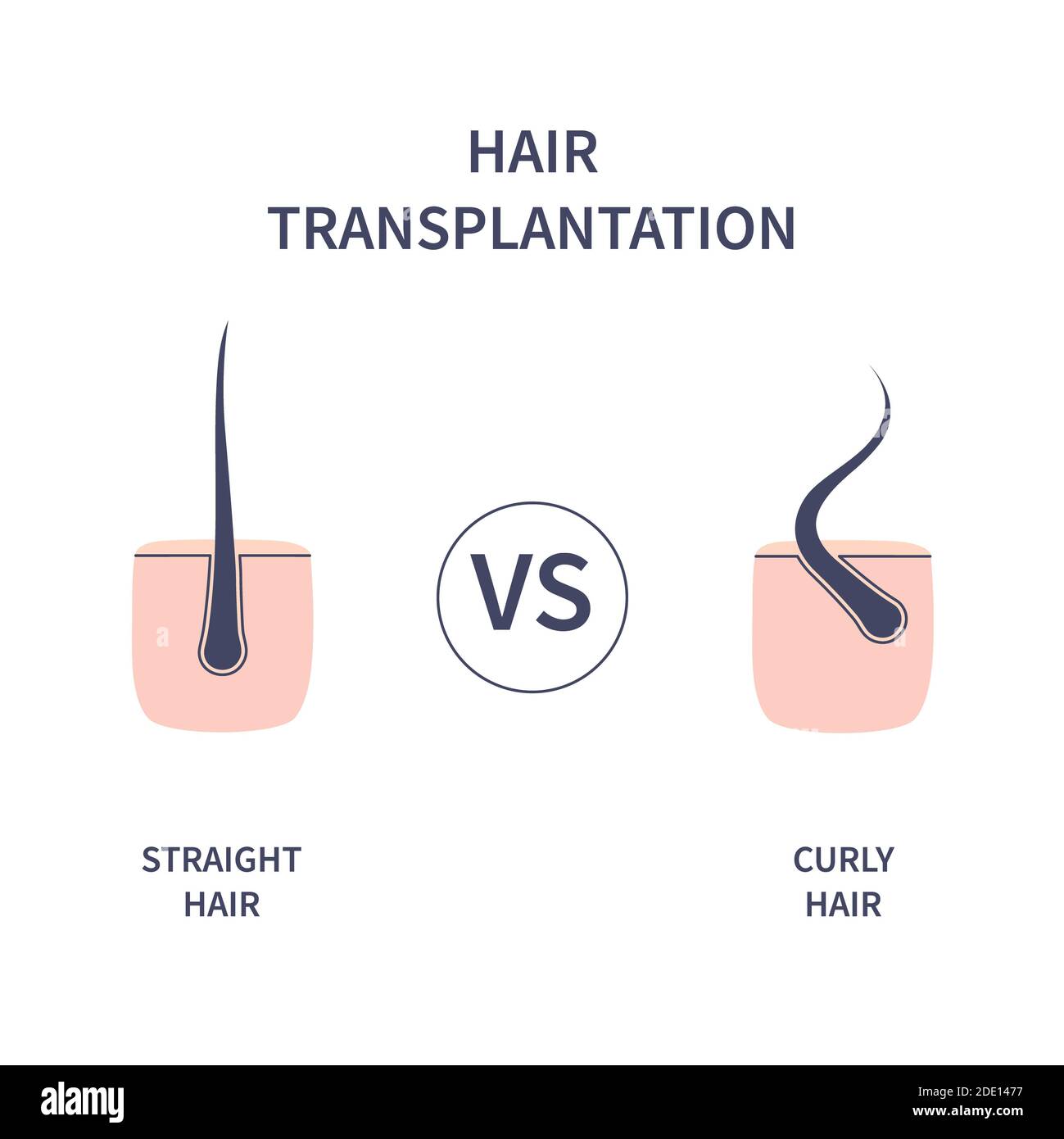 Haartransplantation, Illustration Stockfoto