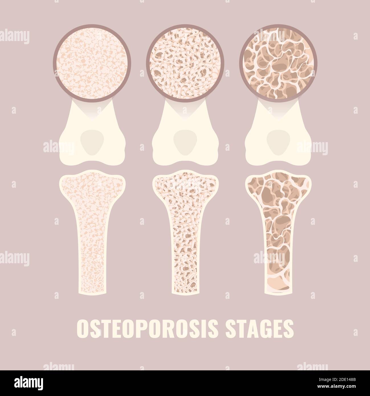 Osteoporose-Stadien, Illustration Stockfoto