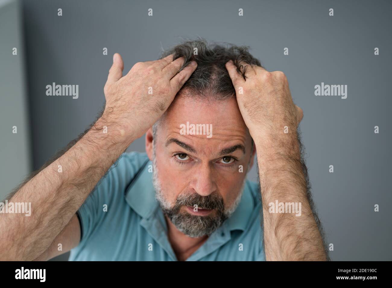 Mann Überprüft Seinen Haarausfall Und Schuppen Stockfoto