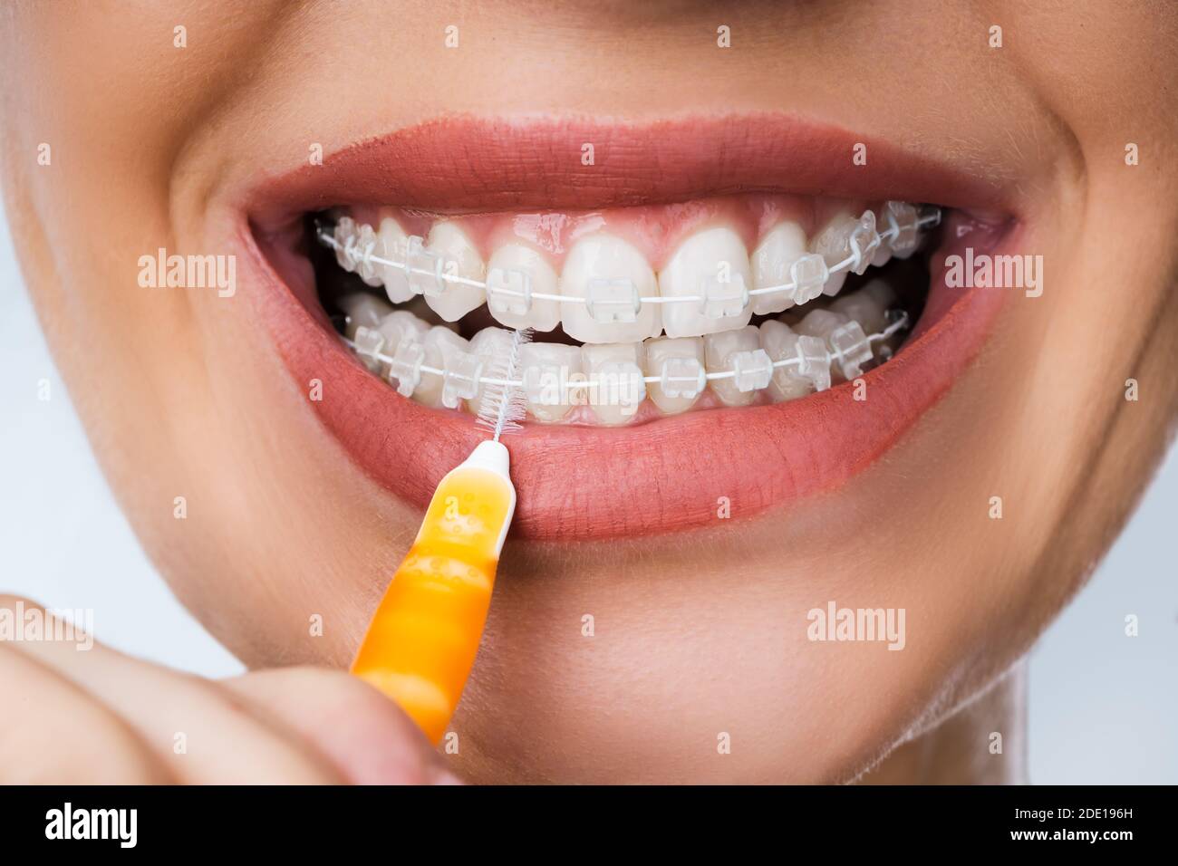 Weibliche Reinigung Zahnhalterungen Im Mund Mit Zahnbürste Stockfoto