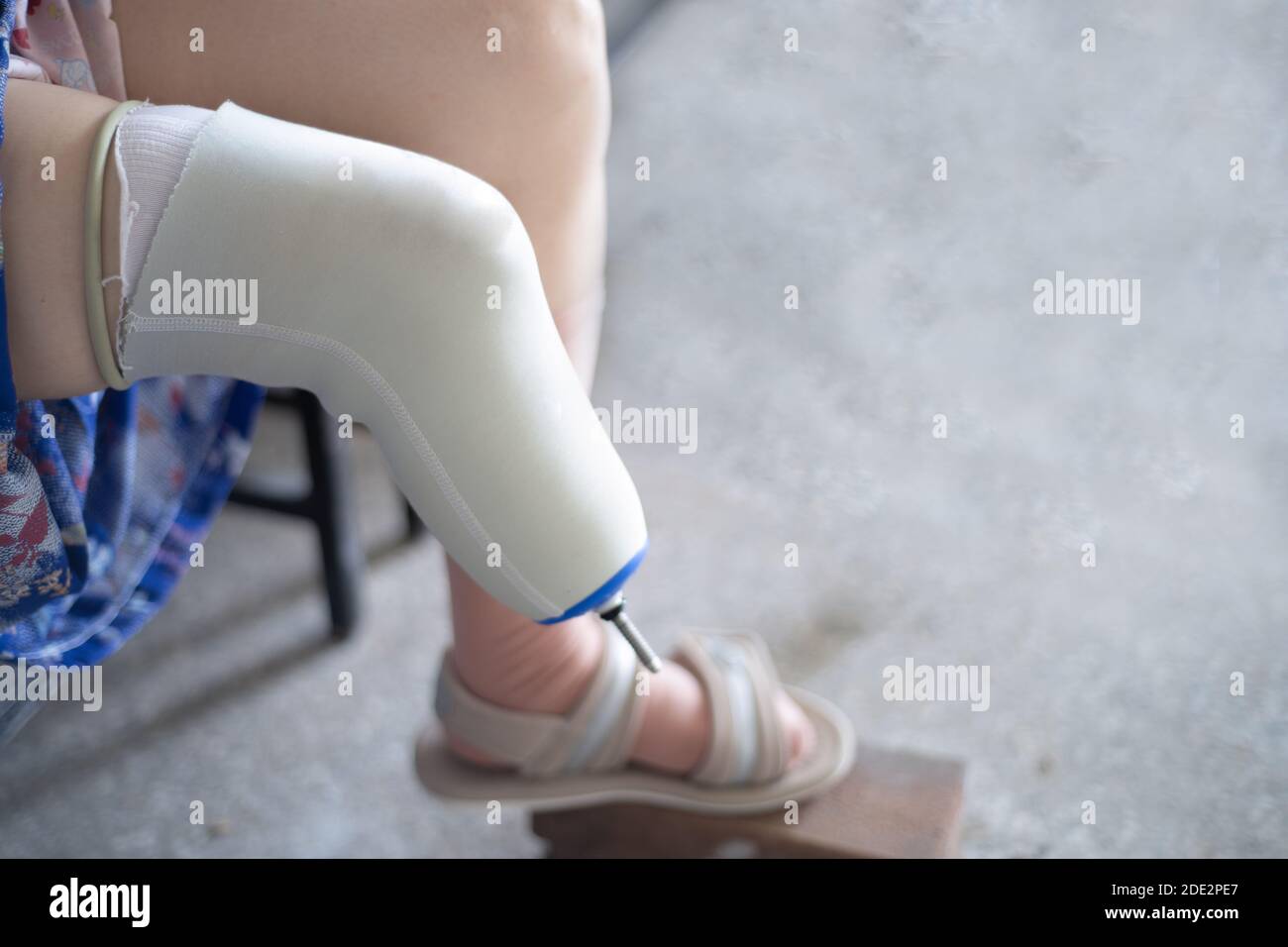 Bilateral Amputation Stockfotos Und Bilder Kaufen Alamy