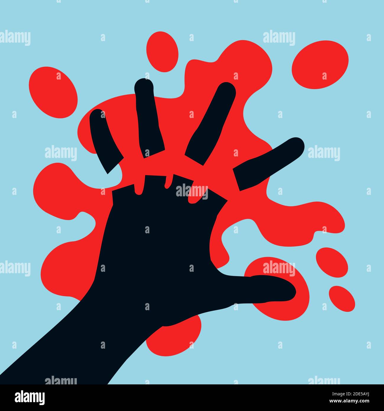 Verletzung und Unfall, die zur Amputation der Finger an der Hand führen - Finger werden abgeschnitten und abgehackt. Blutfleck um die Handfläche. Vektordarstellung Stockfoto