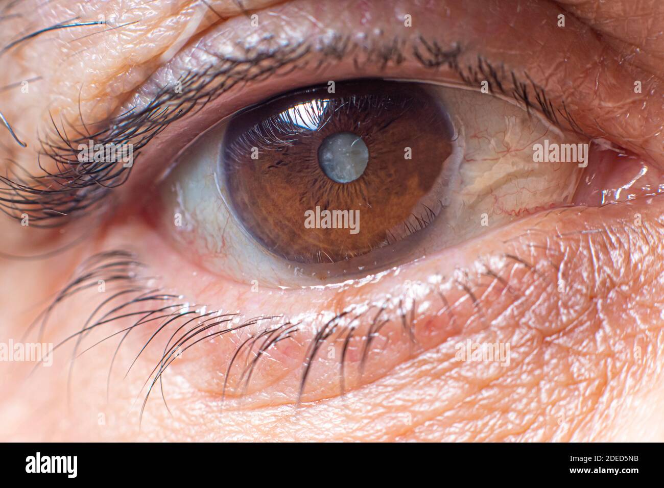 Makrofotos des menschlichen Auges - Katarakt Trübung der Linse, Verschlechterung des Sehvermögens. Kataraktbehandlung, Chirurgie und Augenheilkunde Stockfoto