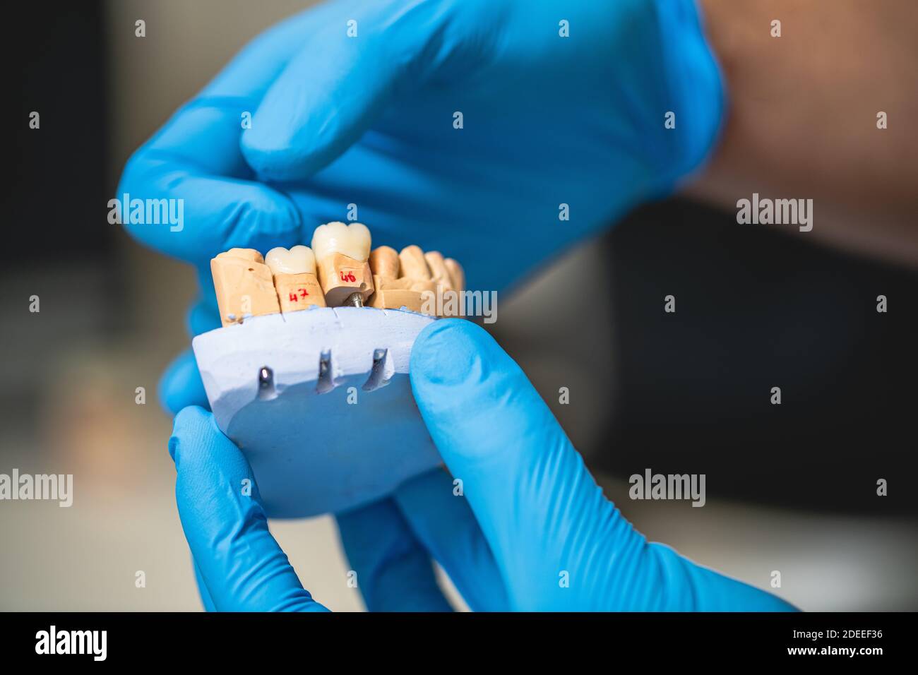 Zahnprothese, Prothesen, Prothetik arbeiten. Prothetik Hände während der Arbeit an der Prothese. Stockfoto