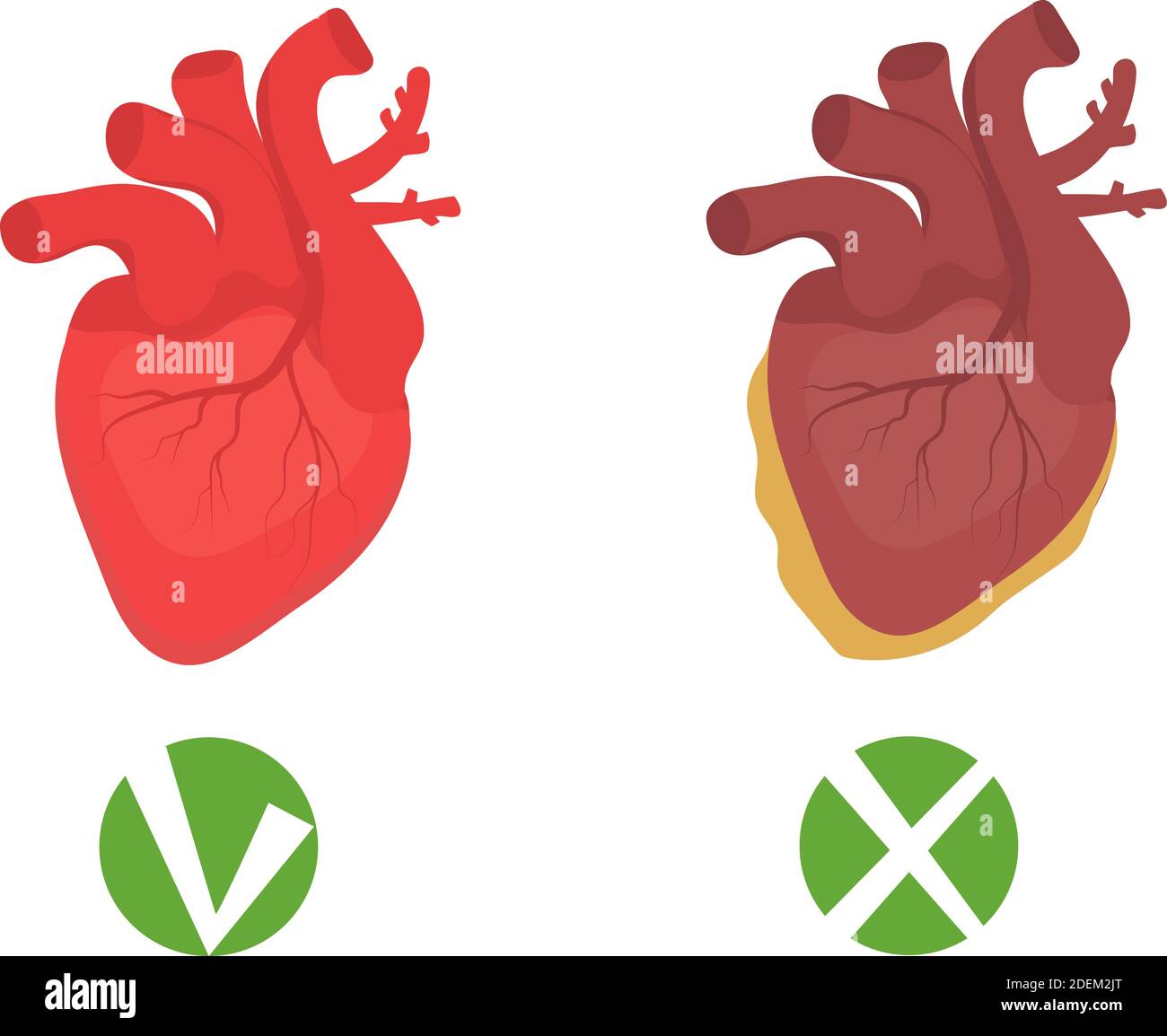 Gesundes Herz und ungesunde Herz fettige Infografiken. Menschliches Organ, Medizinkonzept. Vektorgrafik Stock Vektor