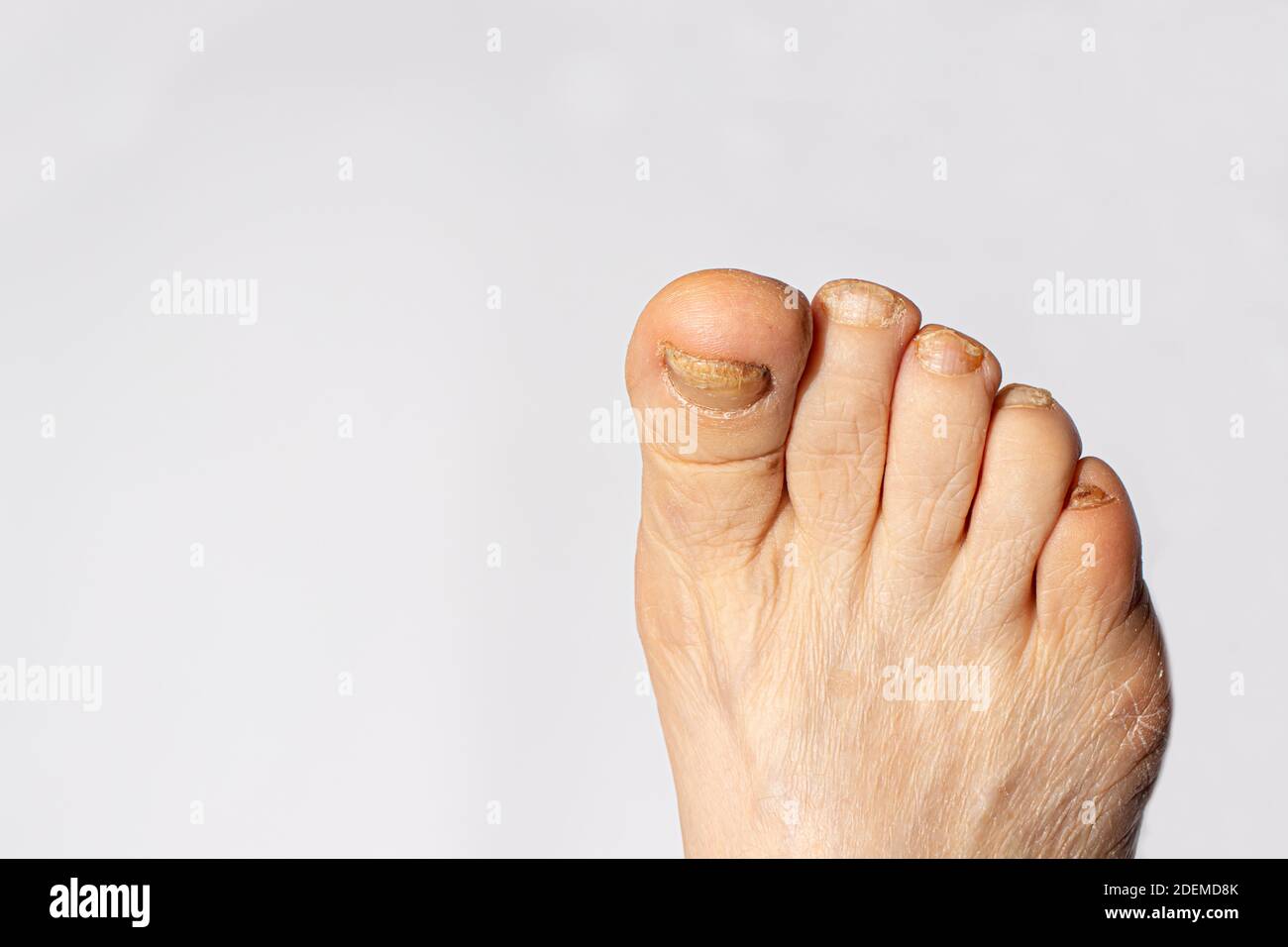 Pilz der Nägel auf der großen Zehe - Dermatomykose und Onychomykose, Pilzinfektion Makro Foto. Dermatologie, Behandlung der Nagelmykose. Stockfoto