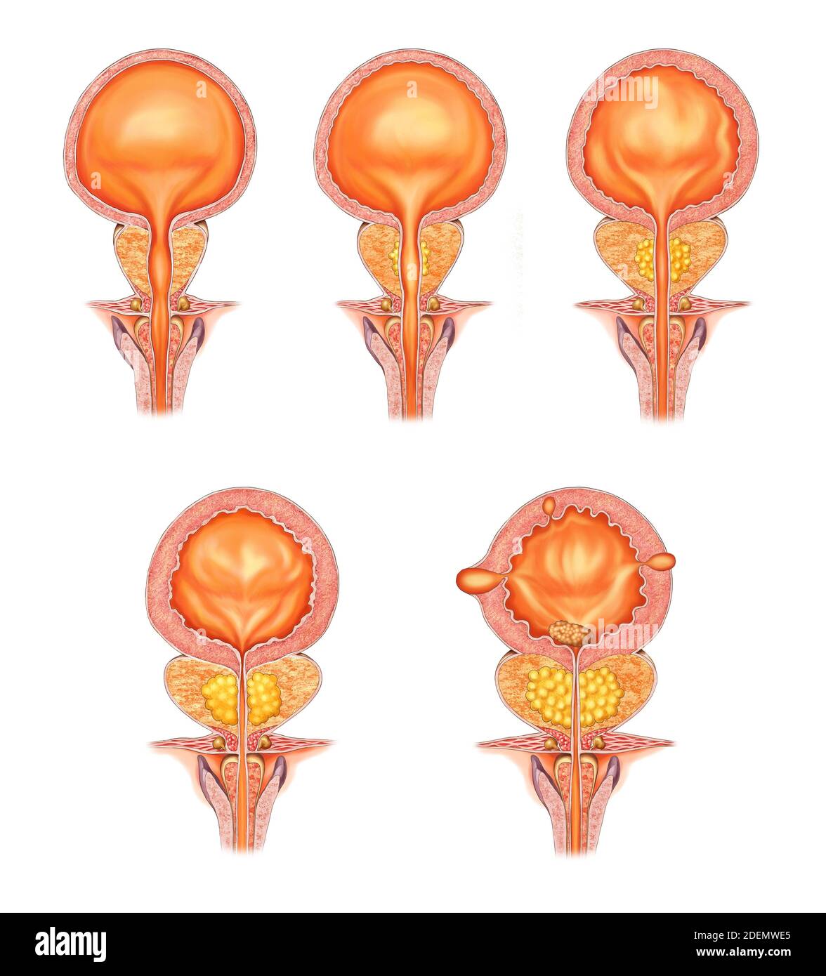 Anatomische Darstellung der Prostataerkrankung Stockfoto