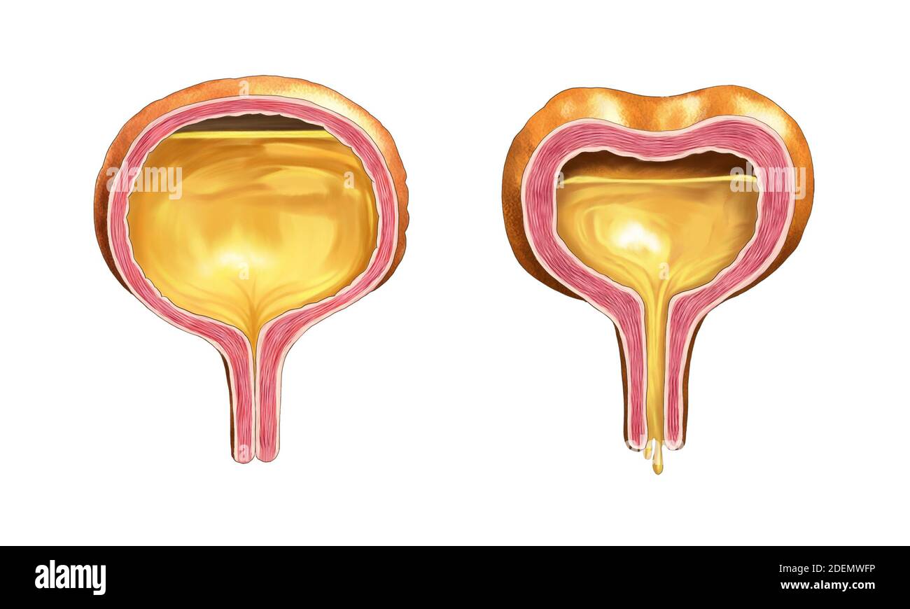 Normale und überempfindliche Blasenanatomie Stockfoto