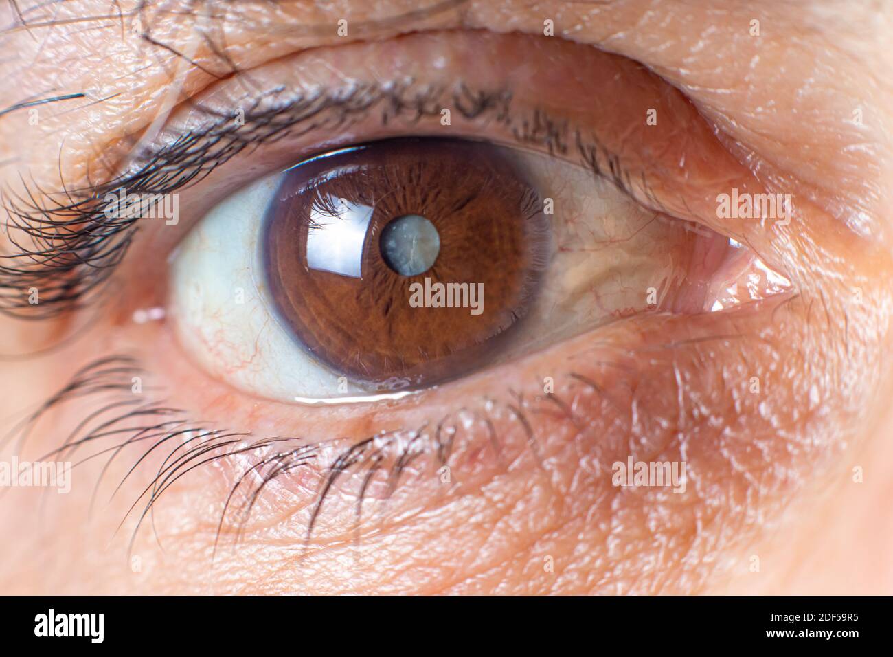 Makrofotos des menschlichen Auges - Katarakt Trübung der Linse, Verschlechterung des Sehvermögens. Kataraktbehandlung, Chirurgie und Augenheilkunde Stockfoto