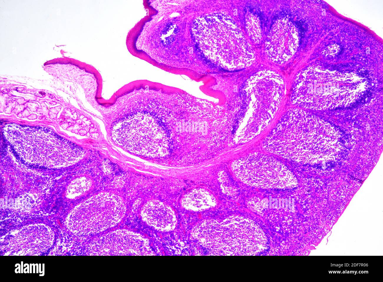Humaner tonsillen-Abschnitt mit kreisförmigen lymphoiden Follikeln und sekretorischen Drüsen. Helle Mikrographie, Hämatoxylin-Eosin-Färbung. X30 beim Drucken Stockfoto