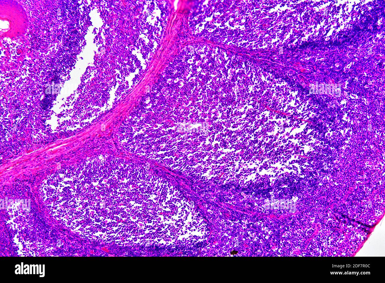 Humaner tonsillen-Abschnitt mit kreisförmigen lymphoiden Follikeln und sekretorischen Drüsen. Helle Mikrographie, Hämatoxylin-Eosin-Färbung. X75 beim Drucken Stockfoto