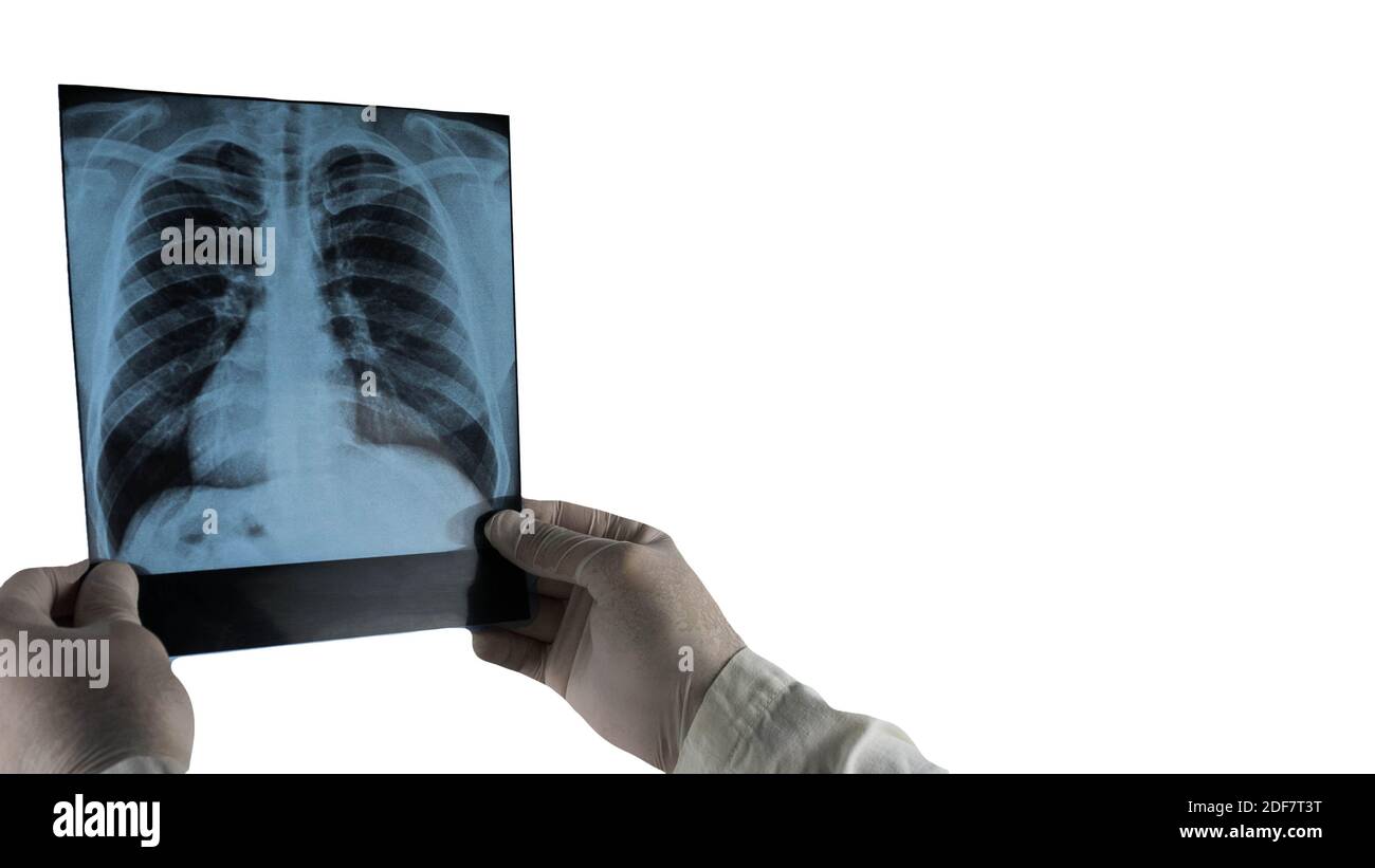 Röntgenaufnahme der menschlichen Lunge isoliert auf weiß. Stockfoto