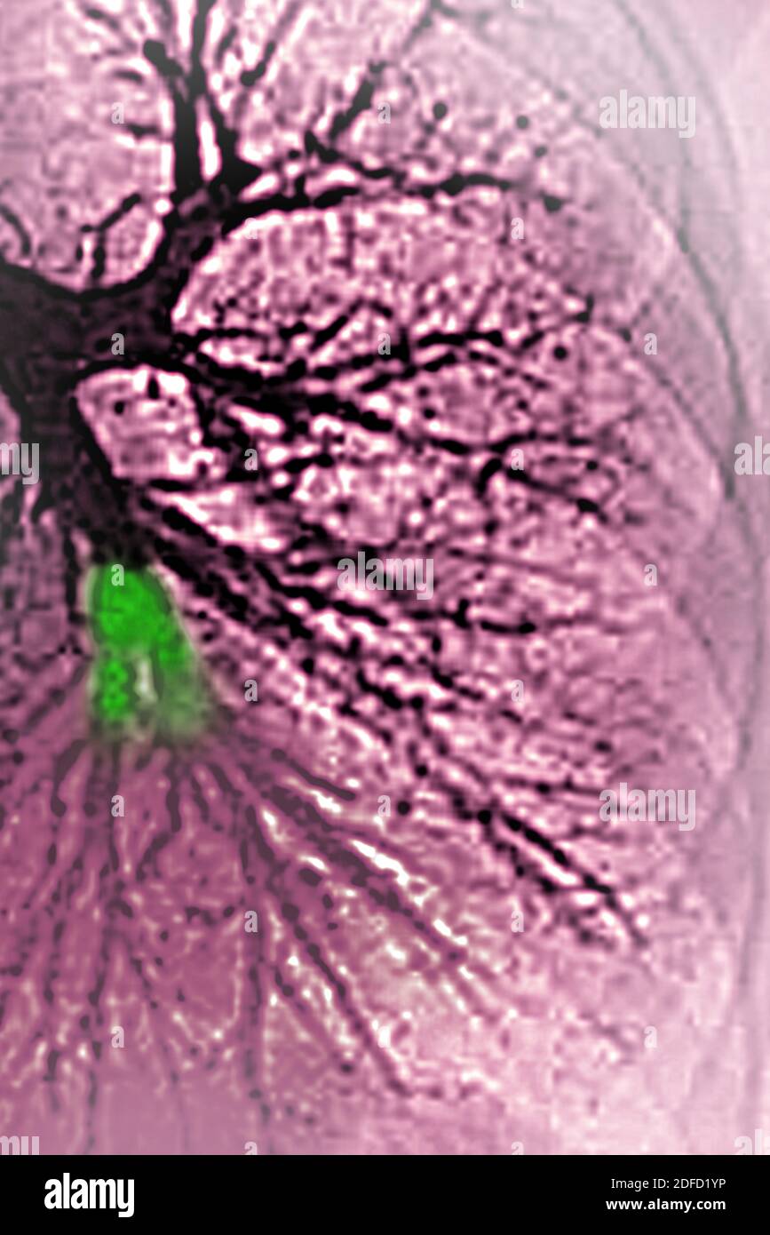 Lungenembolie im linken unteren Lappen (Pulmonalarterie durch ein Blutgerinnsel blockiert). Thorakale Angiographie. Stockfoto