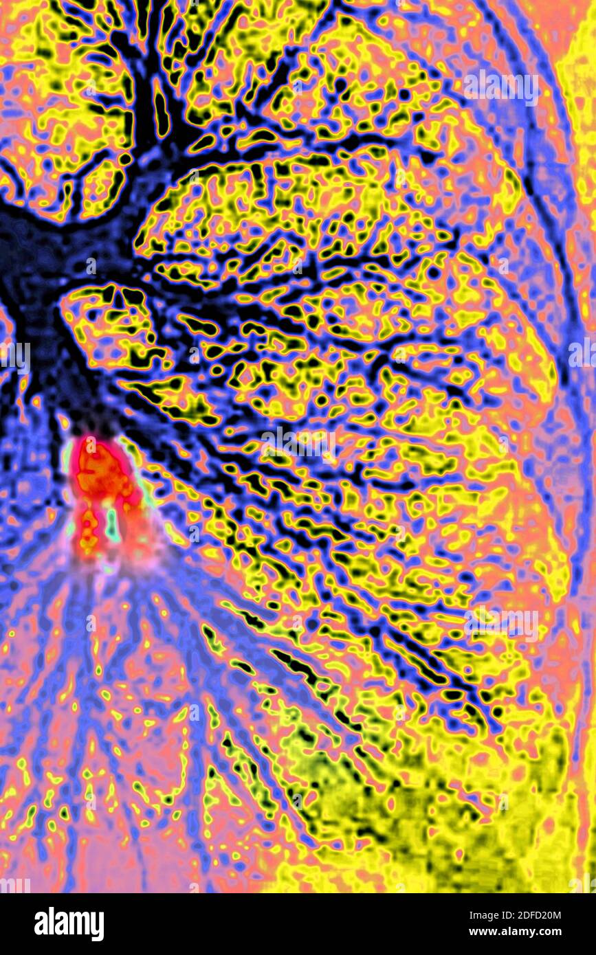 Lungenembolie im linken unteren Lappen (Pulmonalarterie durch ein Blutgerinnsel blockiert). Thorakale Angiographie. Stockfoto