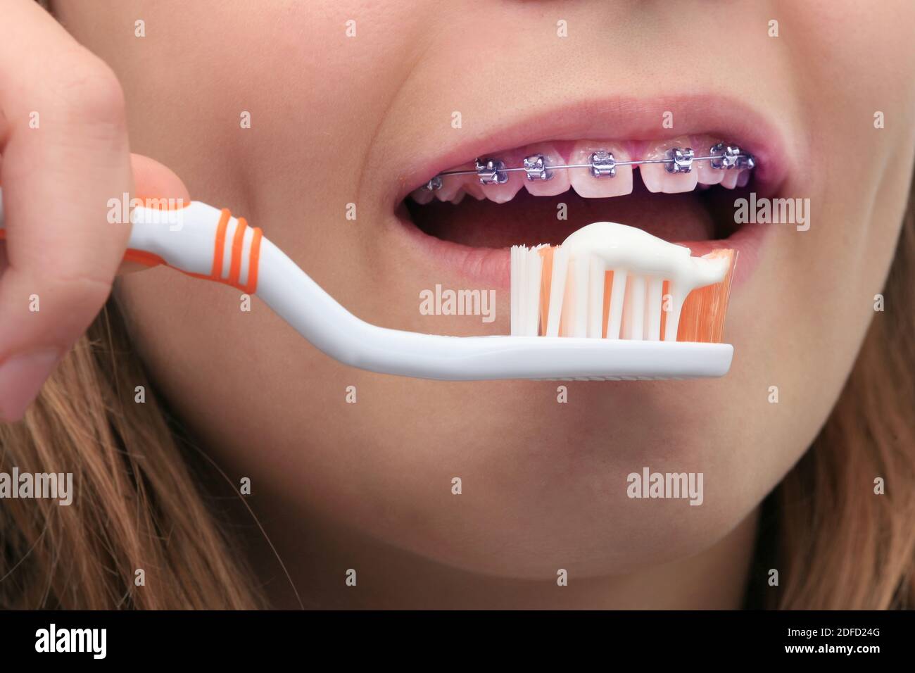Zahnspangen, Zähneputzen Stockfoto