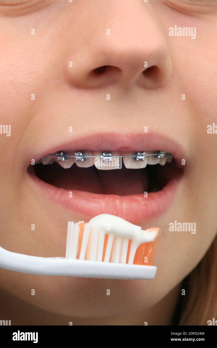 Zahnspangen, Zähneputzen Stockfoto