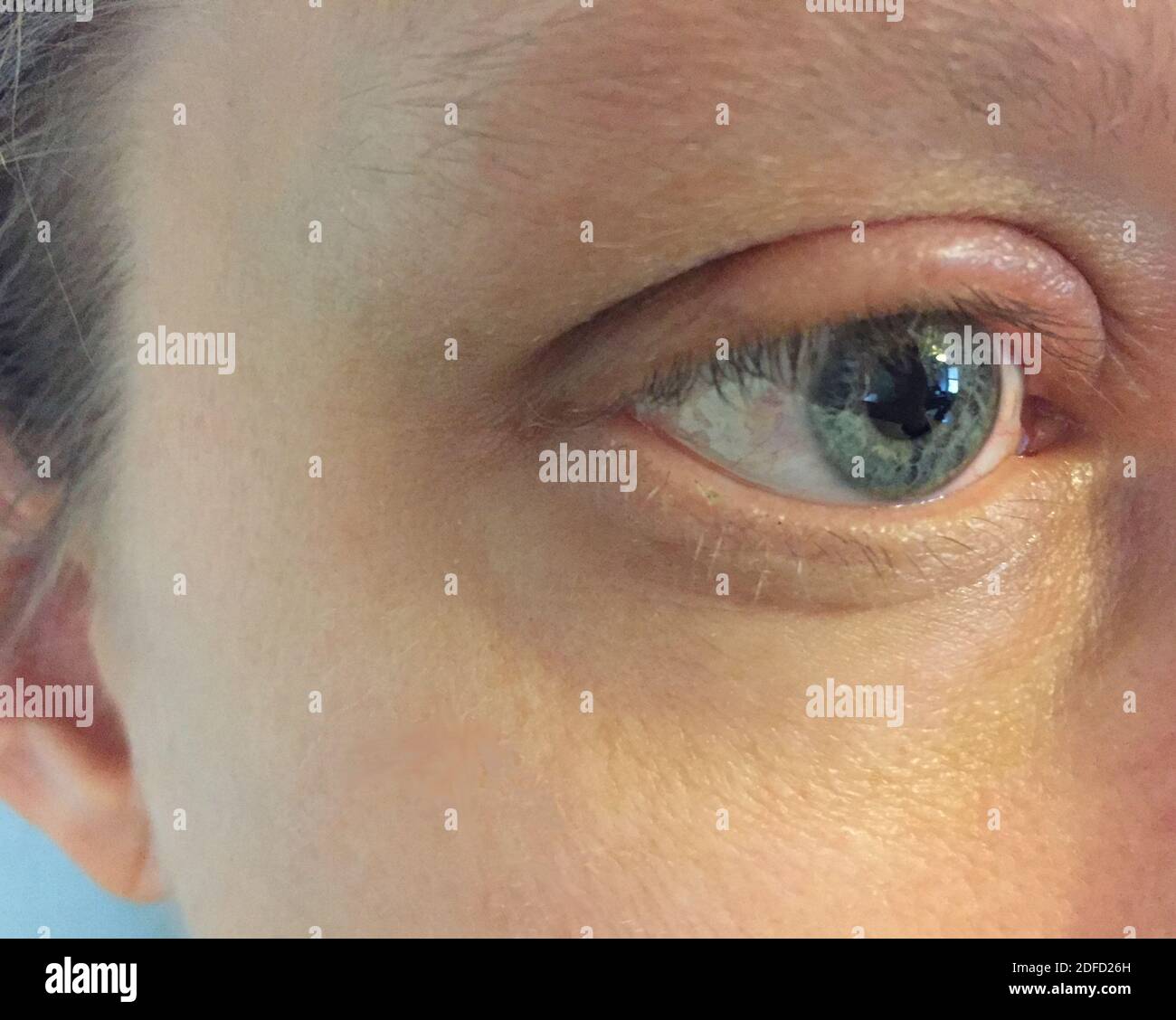 Geschwollenes Augenlid durch Allergie Stockfoto