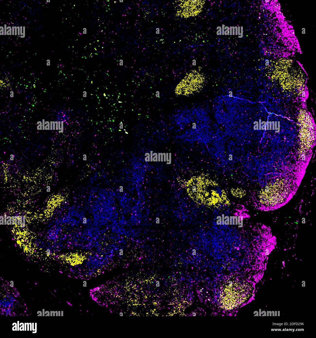 Lymphknoten der Person ohne hiv Stockfoto