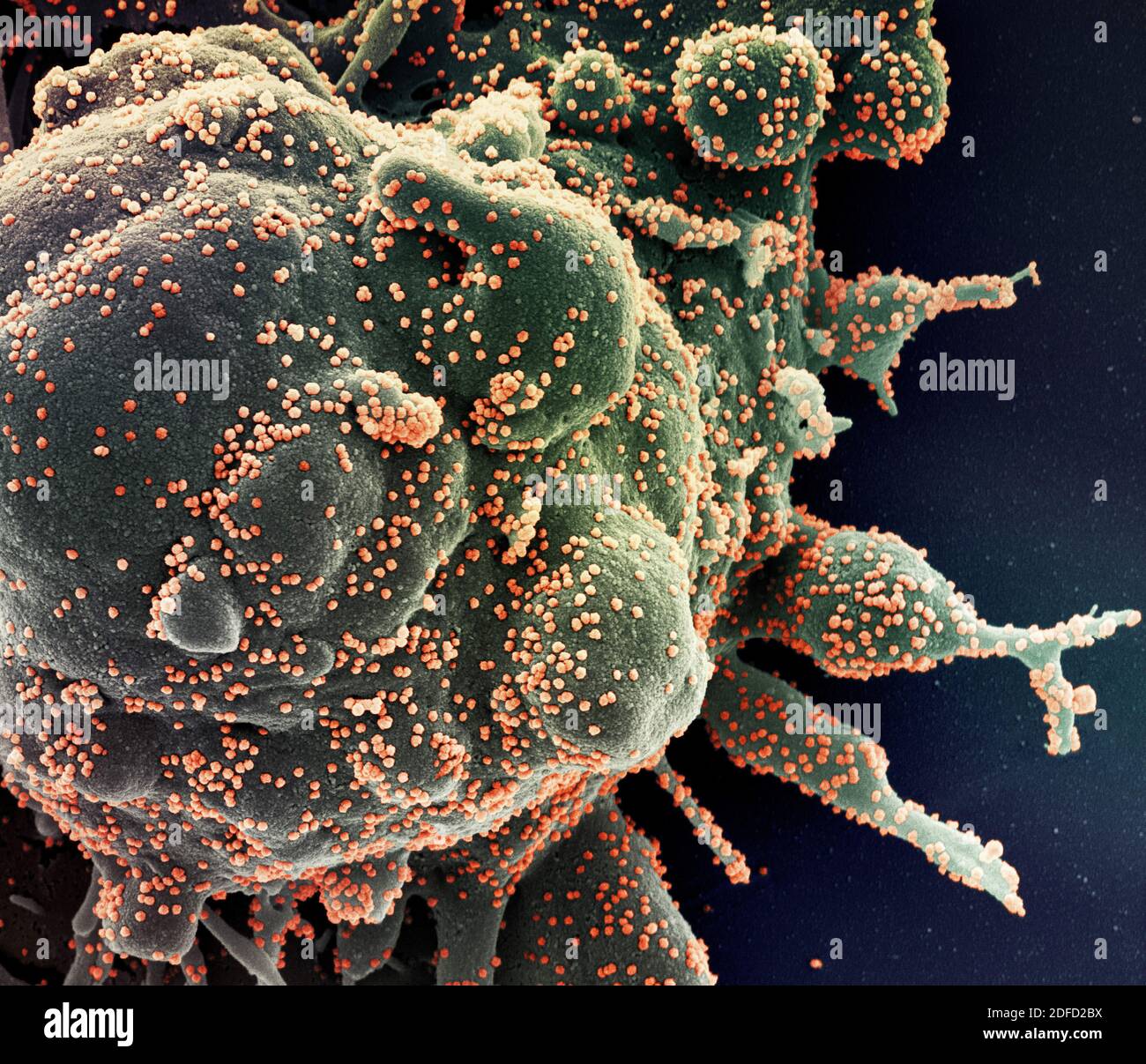 Eingefärbtes Rasterelektronenmikrograph einer apoptotischen Zelle (grün), die stark mit SARS-COV-2-Viruspartikeln (orange) infiziert ist und von einem Patienten isoliert ist Stockfoto