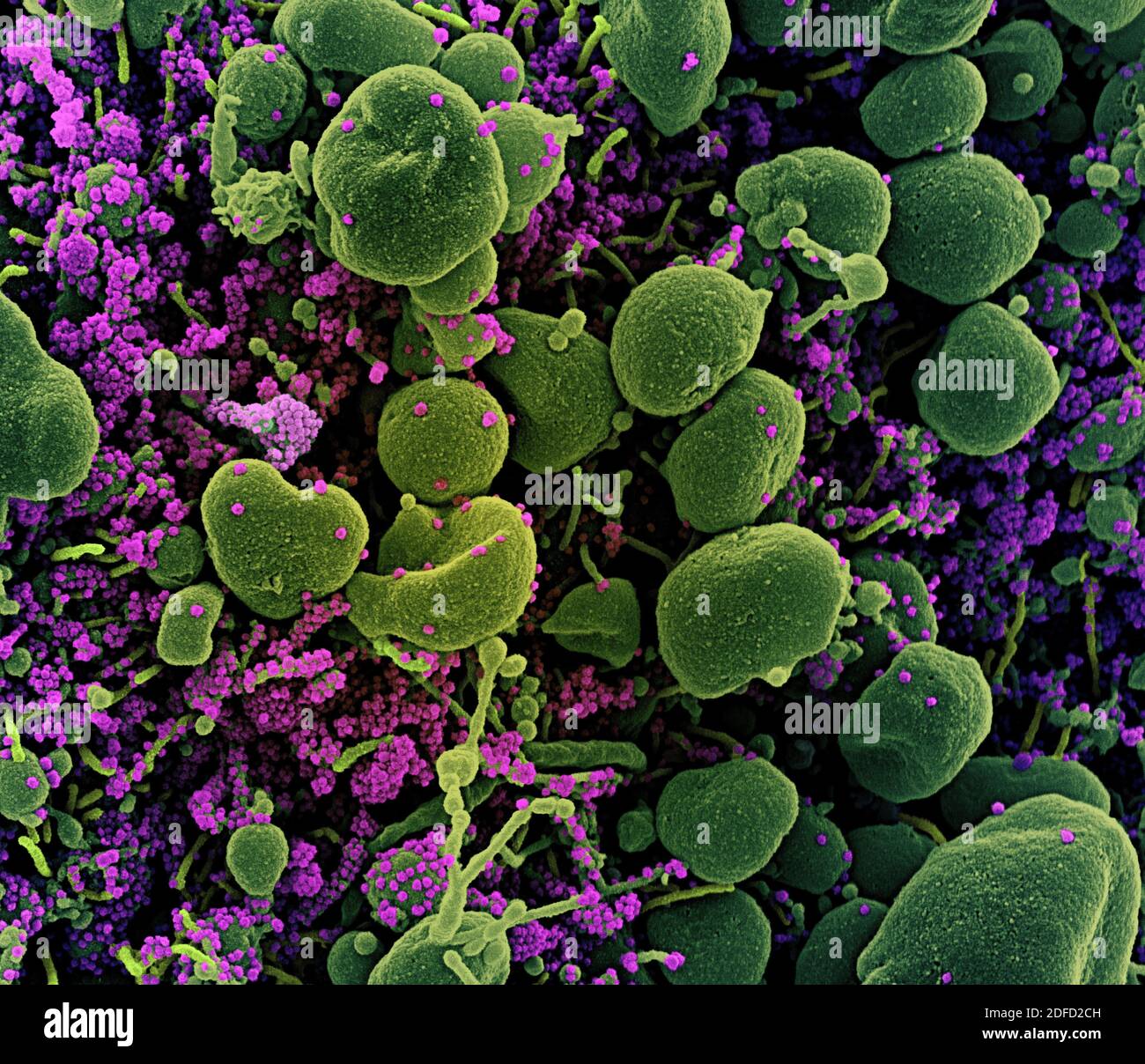 Koloriertes Rasterelektronenmikrograph einer apoptotischen Zelle (grün), die stark mit SARS-CoV-2-Viruspartikeln (violett) infiziert ist und von einem Patienten isoliert ist Stockfoto