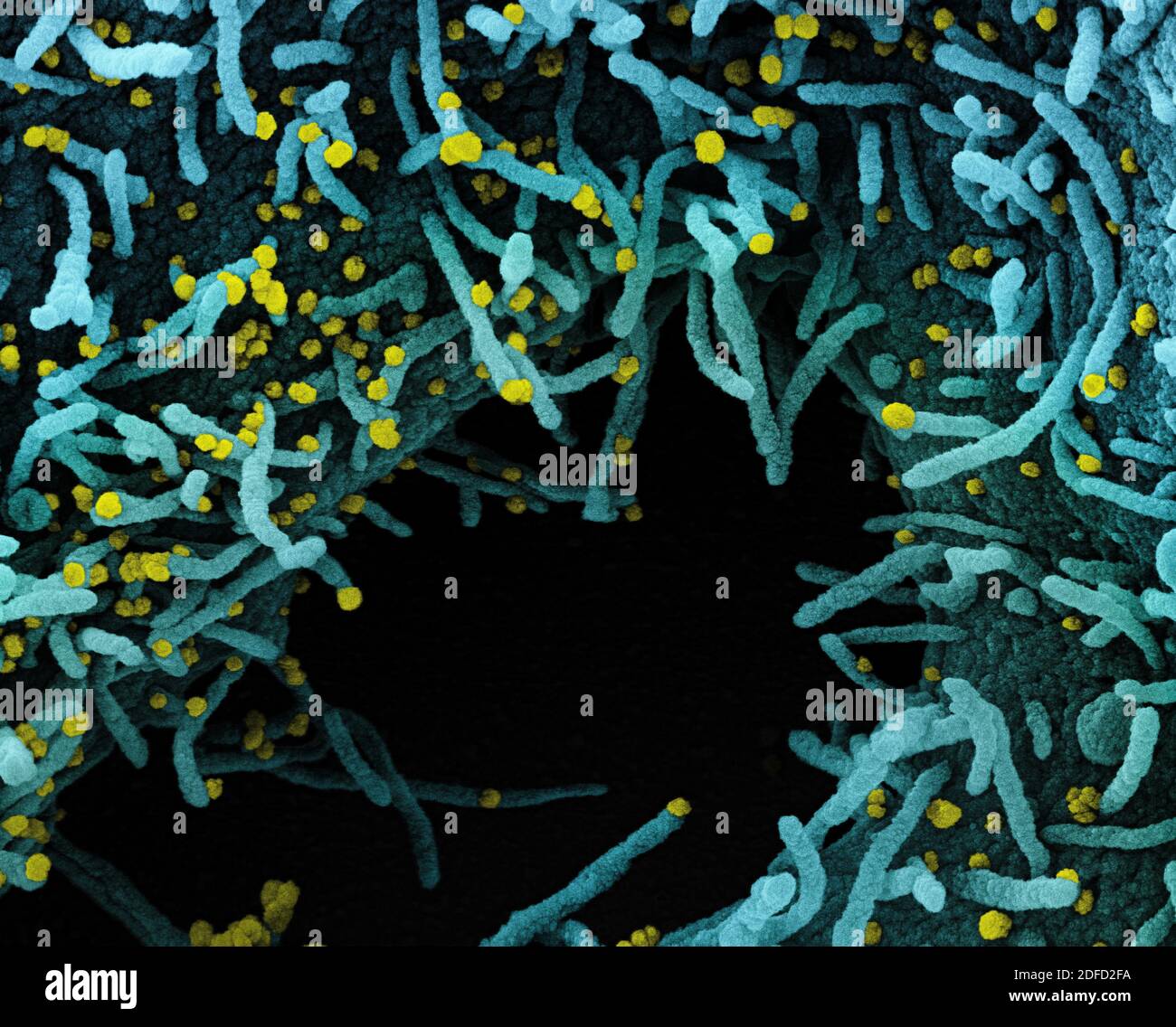 Koloriertes Rasterelektronenmikrograph einer Zelle, die stark mit SARS-CoV-2-Viruspartikeln (gelb) infiziert ist und aus einer Patientenprobe isoliert wurde. Das Schwarz Stockfoto