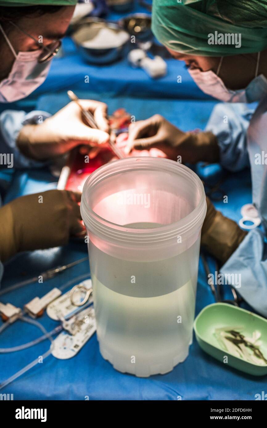 Nierenentfernung durch Laparoskopie von einem lebenden verwandten Spender, der Chirurg ruft und bereitet die Niere in einer kalten Lösung gespeichert, während die warten Stockfoto