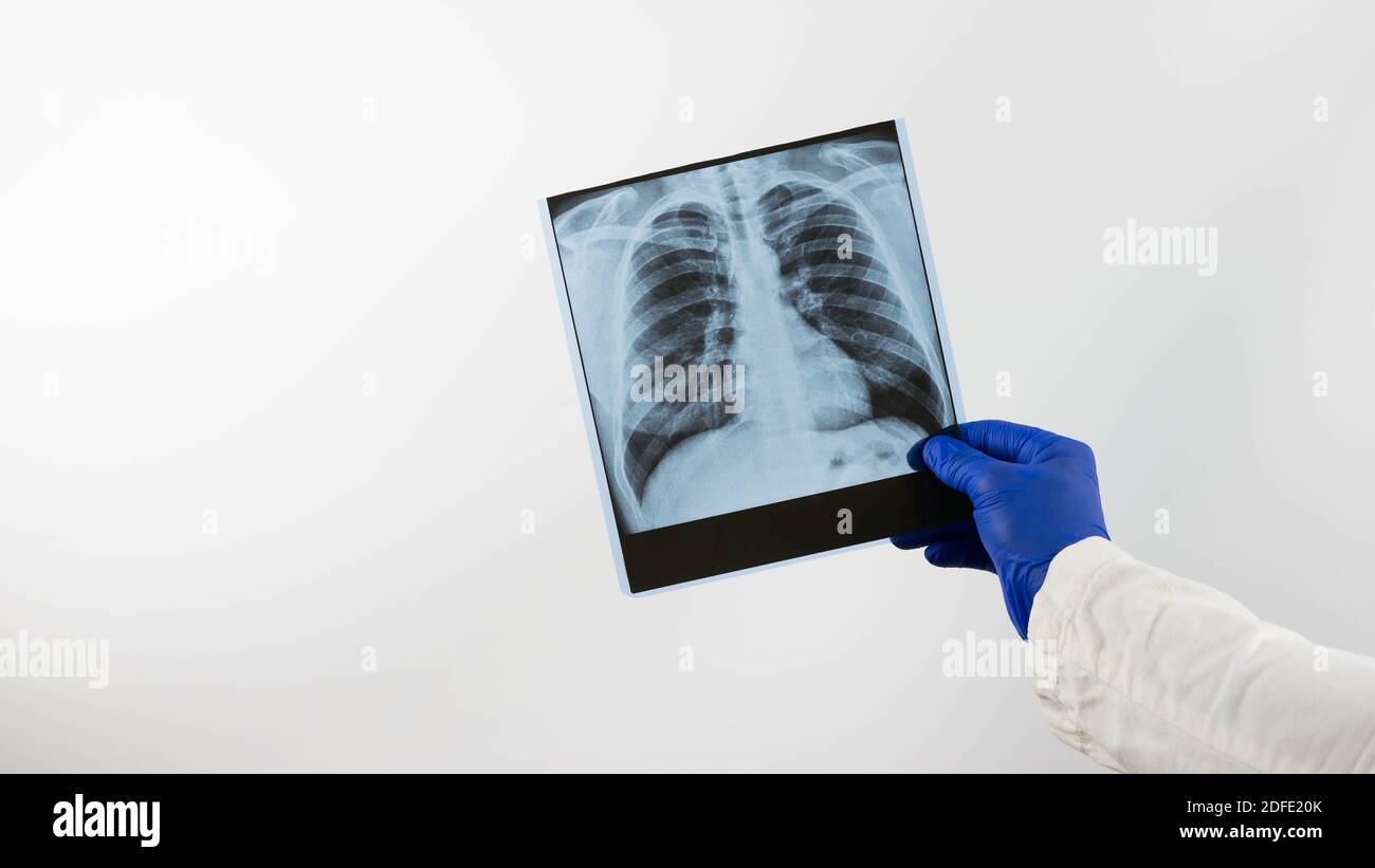 Thorax-Röntgen, Arzt und Lunge Röntgen, close-up.A Arzt in einem Krankenhaus diagnostiziert eine Lungenerkrankung. Stockfoto
