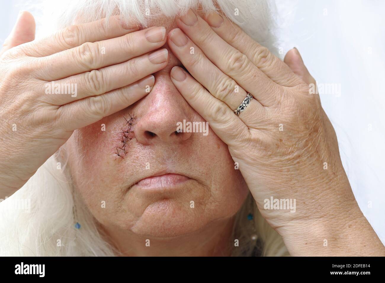 Eine ältere Frau hat eine Narbe im Gesicht und schämt sich dafür. Mit Narben im Gesicht möchte man sich verstecken Stockfoto
