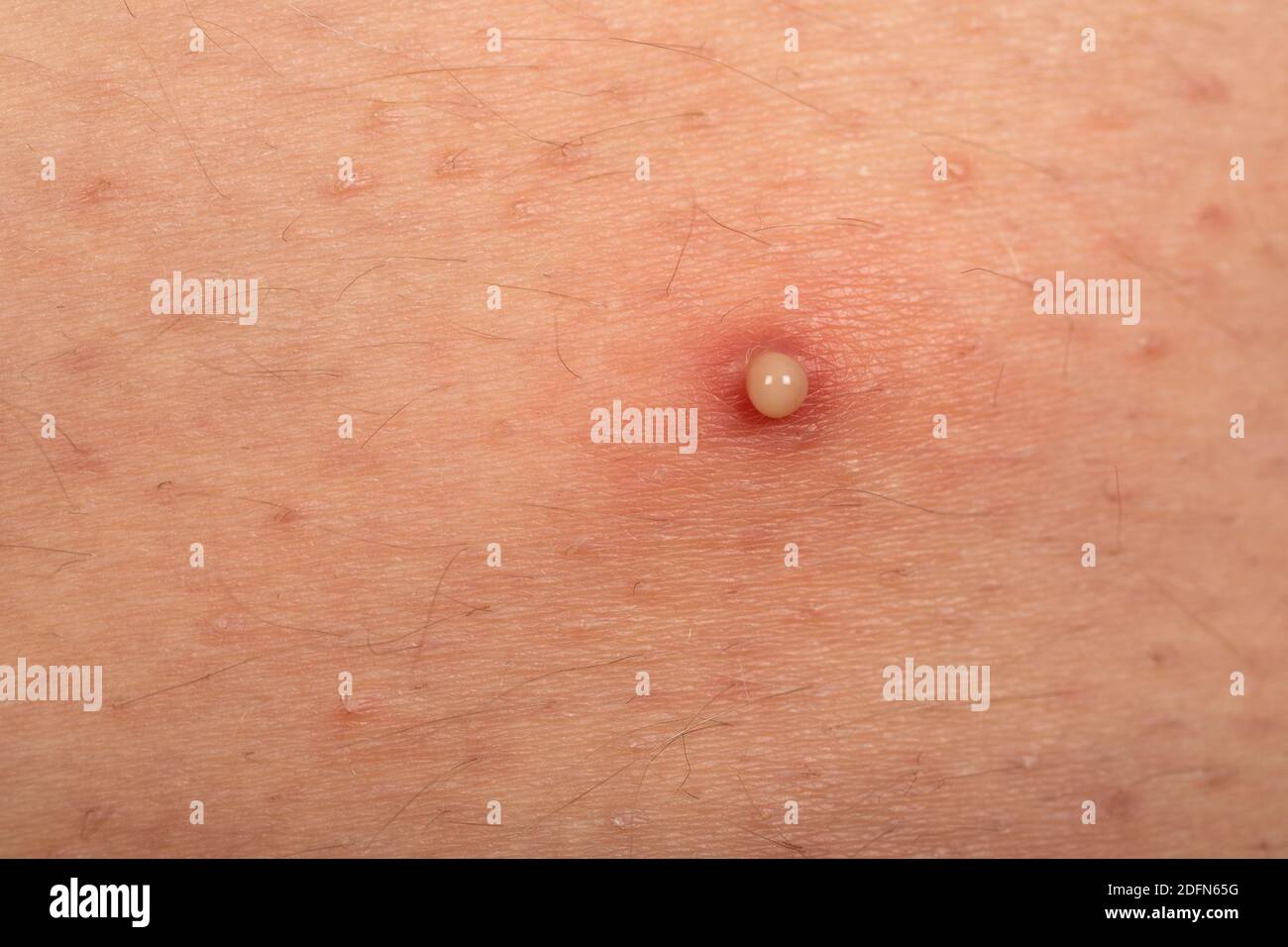 Nahaufnahme Bild von Pickel mit Eiter auf der menschlichen Haut, hormonelle Störung Stockfoto