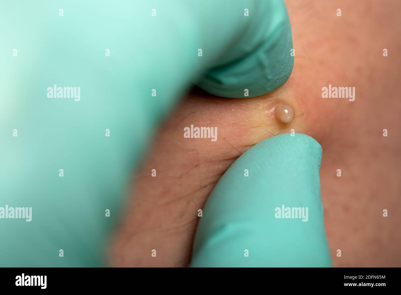 Nahaufnahme der Hände des Arztes, die sterile Handschuhe tragen und den Pickel voll Eiter quetschen Stockfoto
