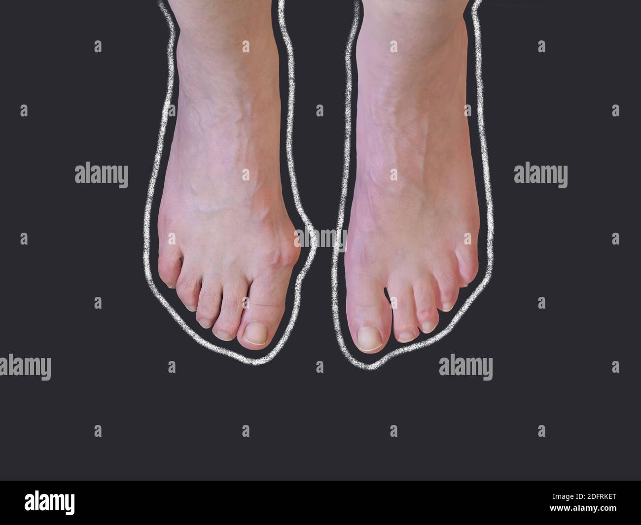 Kreide Umriss von Hallux valgus, Bunion in Frau Fuß auf schwarzem Hintergrund. Overhead-Aufnahme mit Kopierplatz. Stockfoto