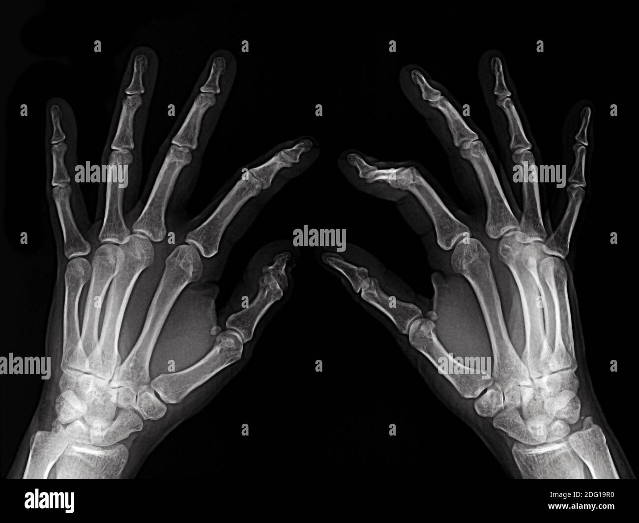 Röntgenstrahlte Hände Stockfoto
