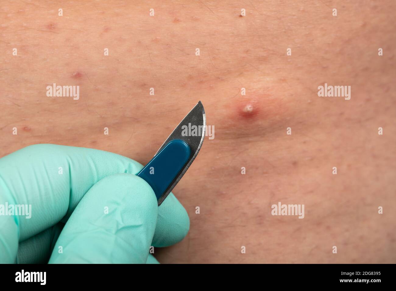 Nahaufnahme des Arztes Hände halten sterile Skalpell als nächstes Zu schmerzhaften Pickel auf der menschlichen Haut Stockfoto