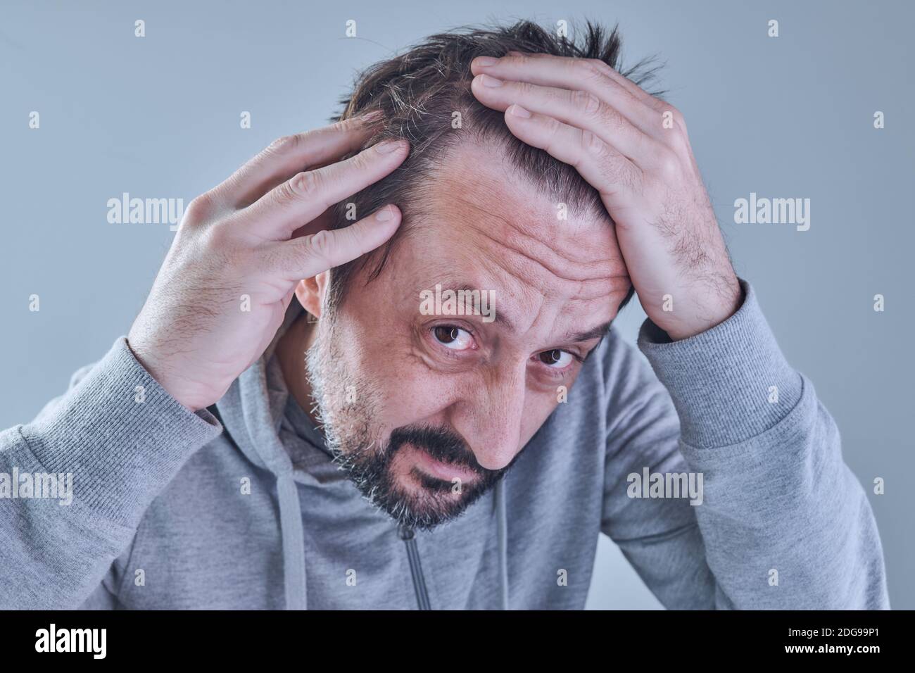 Haarausfall. Mann besorgt über den Verlust von Haaren auf seiner Stirn und Tempel. Porträt eines erwachsenen kaukasischen Mannes in seinen 40er Jahren. Stockfoto