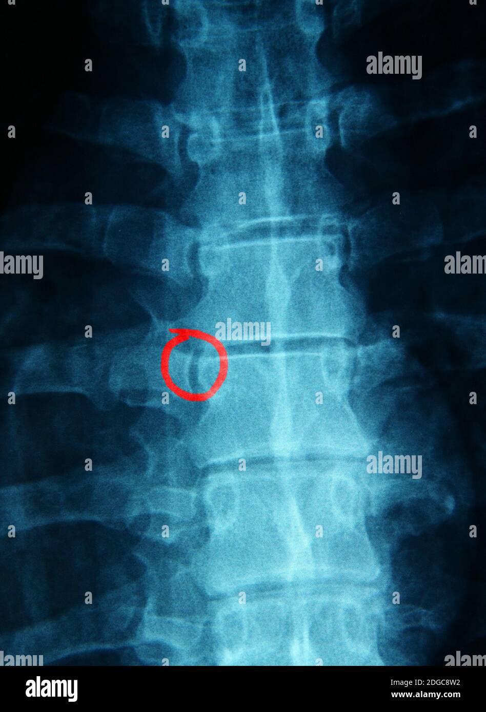 Röntgenaufnahme der Wirbelsäule mit Kreis Stockfoto