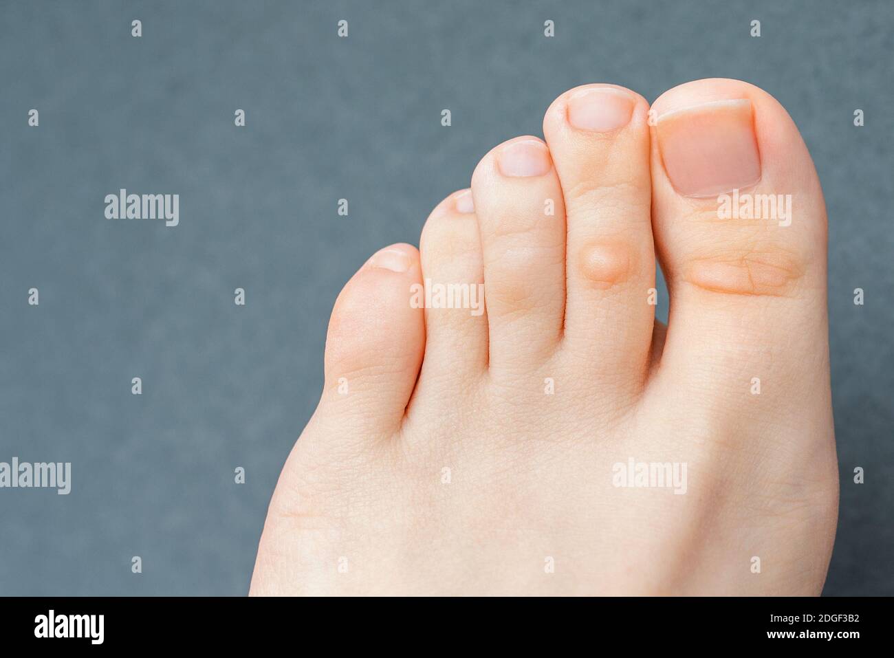 Schmerzhafte knoten -Fotos und -Bildmaterial in hoher Auflösung – Alamy
