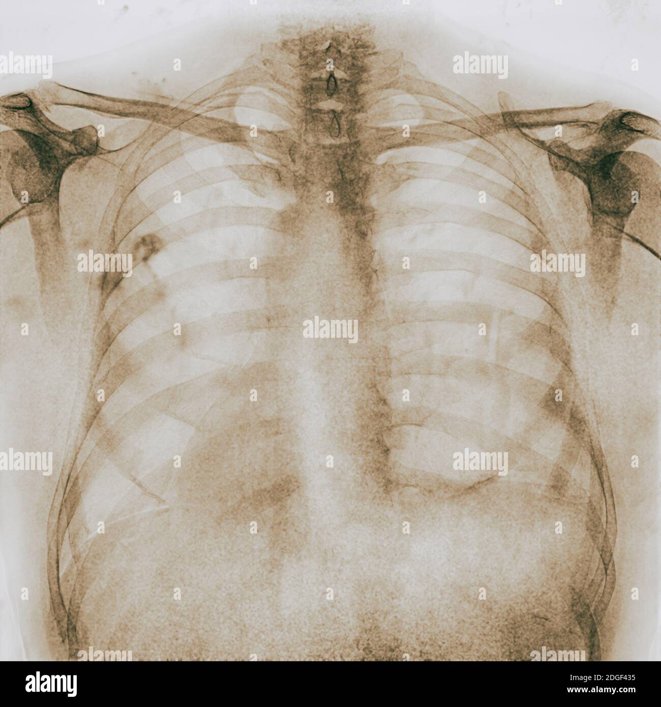 Röntgenbild des menschlichen Thorax - TB-Screening Stockfoto