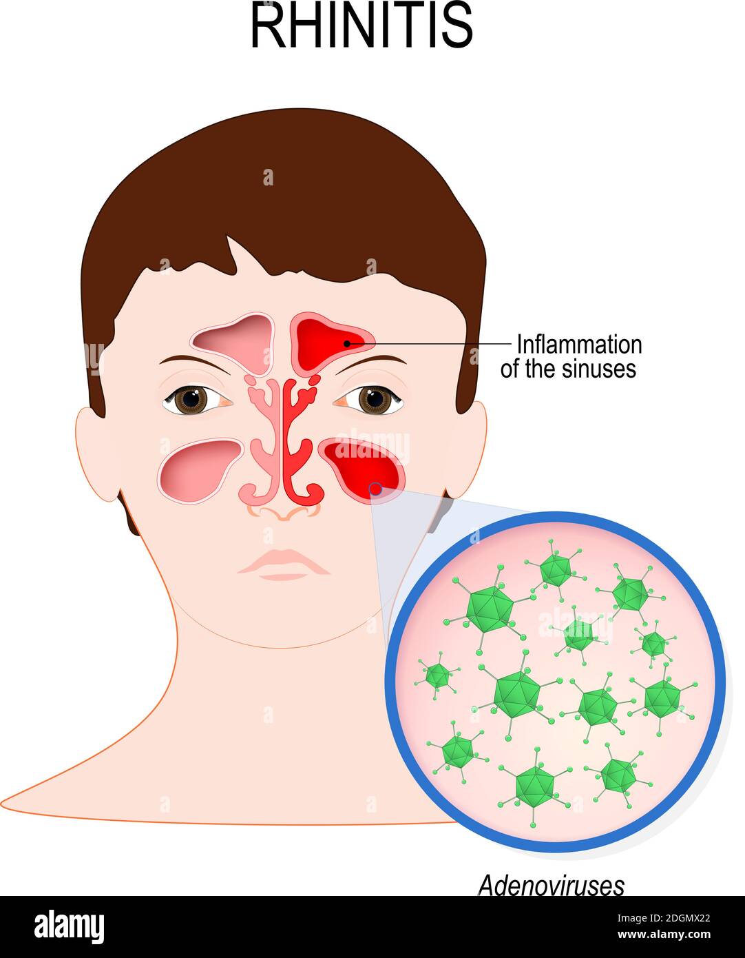 Virale Sinusitis (Rhinitis) durch Adenovirus-Infektion verursacht. Gesicht mit Nasenhöhle und Nahaufnahme Virusinfektion, die diese Krankheit verursacht Stock Vektor