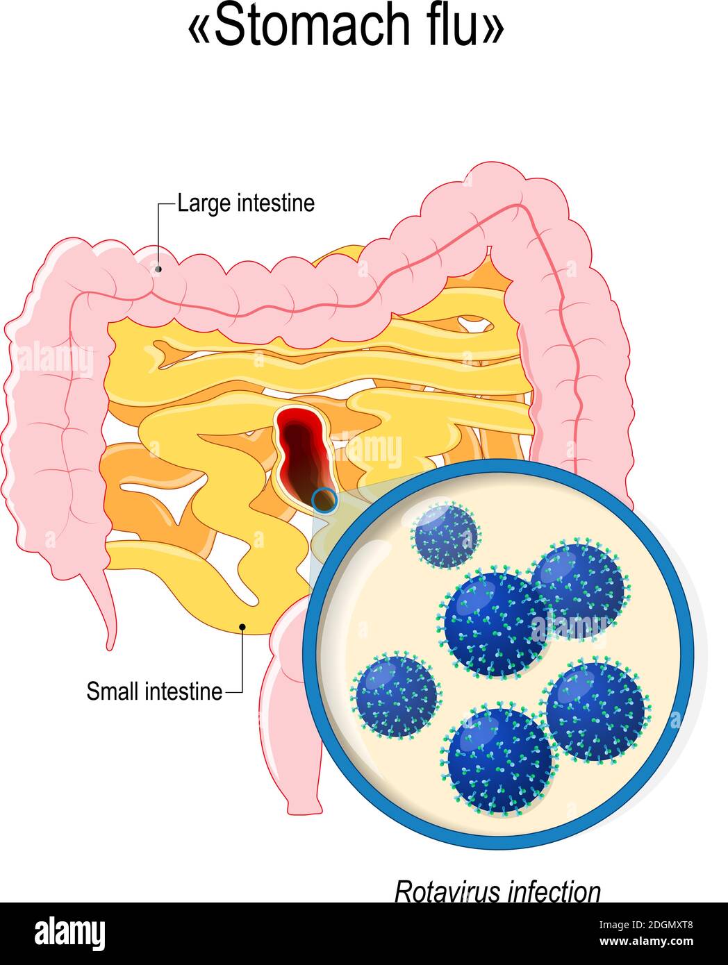 Rotavirus-Infektion oder Magengrippe. Dünndarm, Dickdarm und Nahaufnahme von Rotavirus-Virionen. Menschliche Anatomie. Vektordiagramm für Ihr Design Stock Vektor