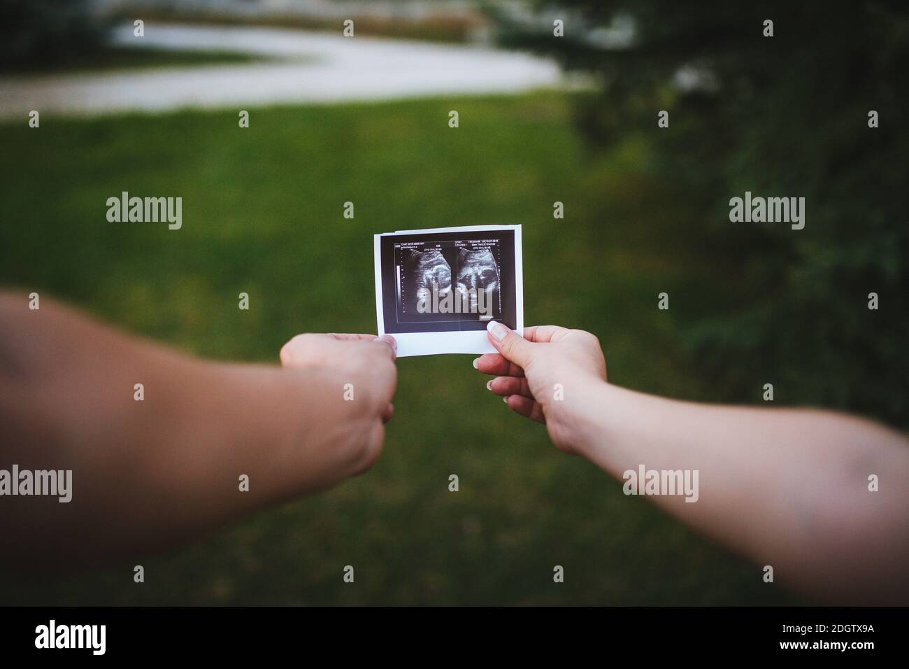 Ultraschalluntersuchung des Babys in den Händen auf grünem Bakkboden Stockfoto