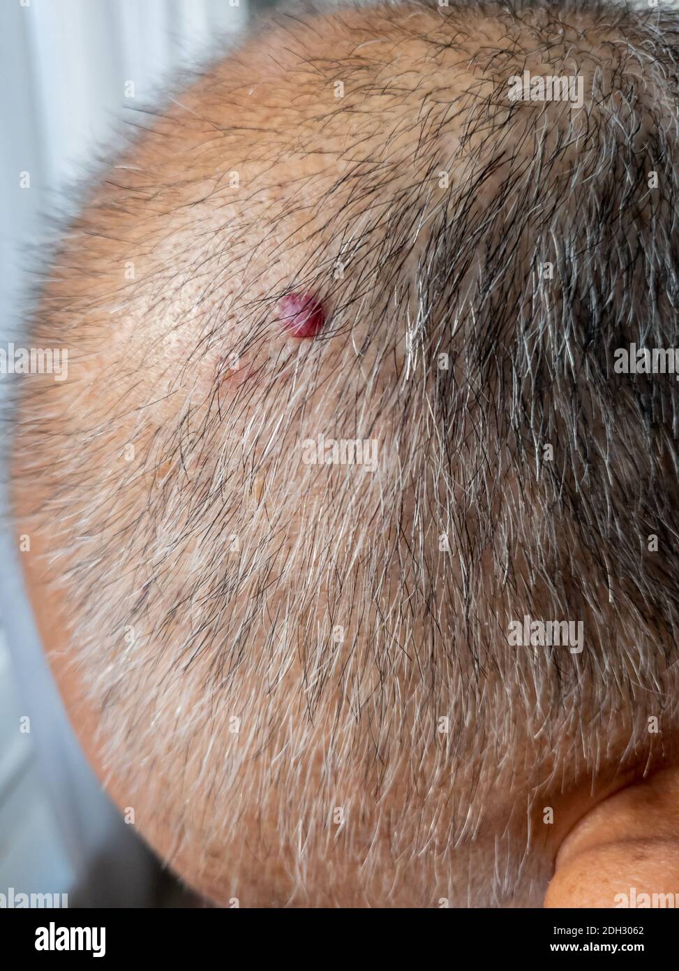 Ein Hautmol normalerweise als Folge der Exposition gegenüber ultraviolettem Licht, das zu Melanom, eine Art von Hautkrebs entwickeln kann. Stockfoto