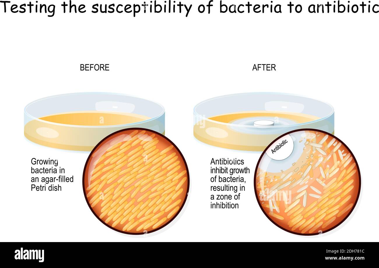 Testen der Anfälligkeit von Bakterien auf Antibiotika. Bakterien wachsen in einer Agar-gefüllten Petrischale. Experimentieren. Die DISK-Diffusion-Agar-Methode testet Stock Vektor