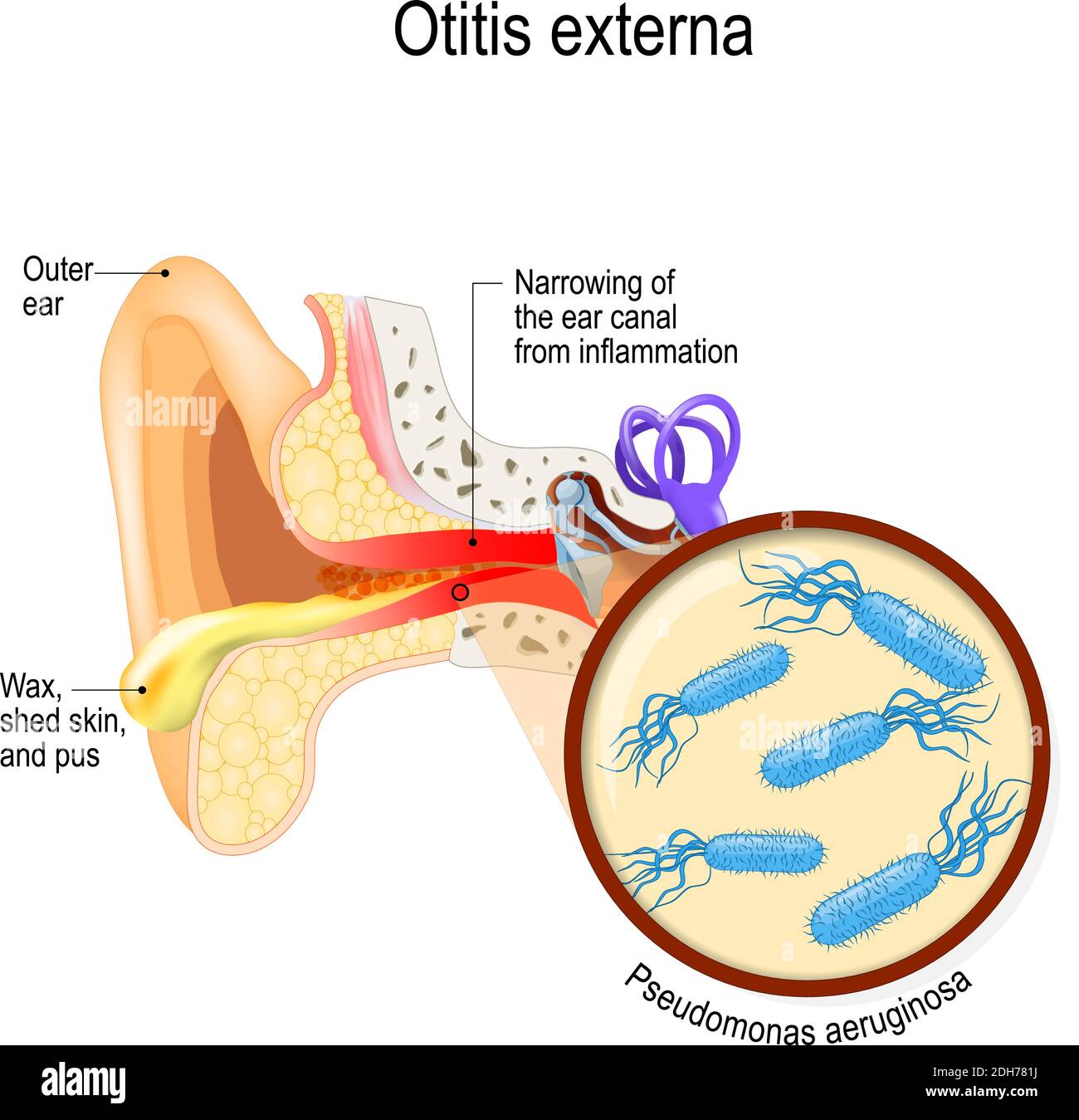 Das Ohr des Schwimmers. Otitis externa ist eine Entzündung des Gehörgangs. Bakterielle Infektionen Krankheit. Nahaufnahme von Pseudomonas aeruginosa. Menschliche Anatomie Stock Vektor